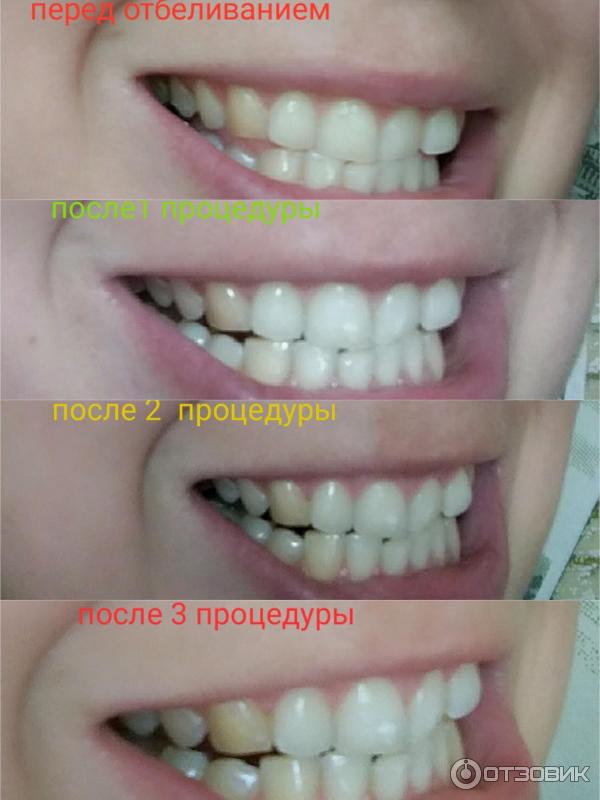 Стоимость отбеливания зубов могилев держатель для зубных щеток купить спб